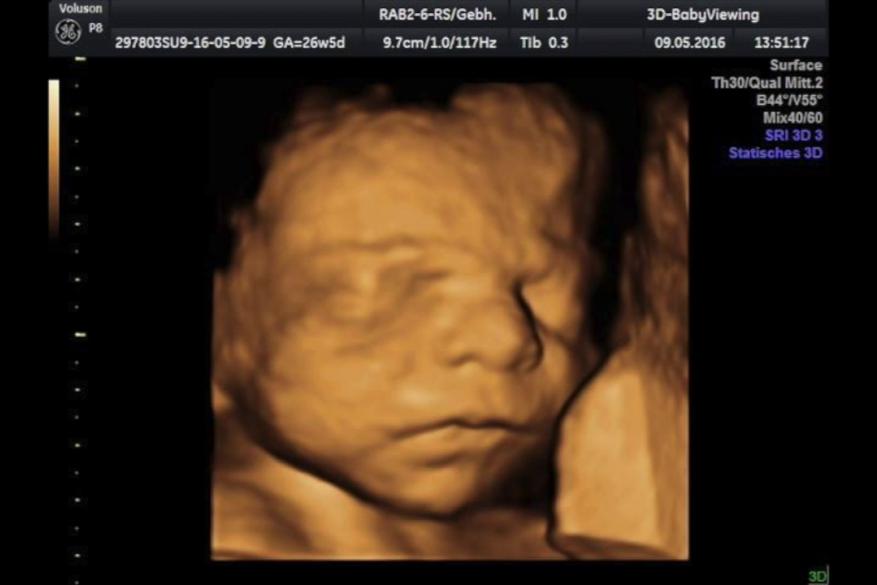 Baby-Ultraschall 3D/ 4D